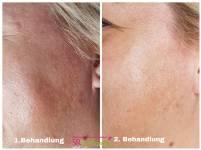 Microneedling vorher nachher