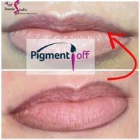 Lippenentfernung